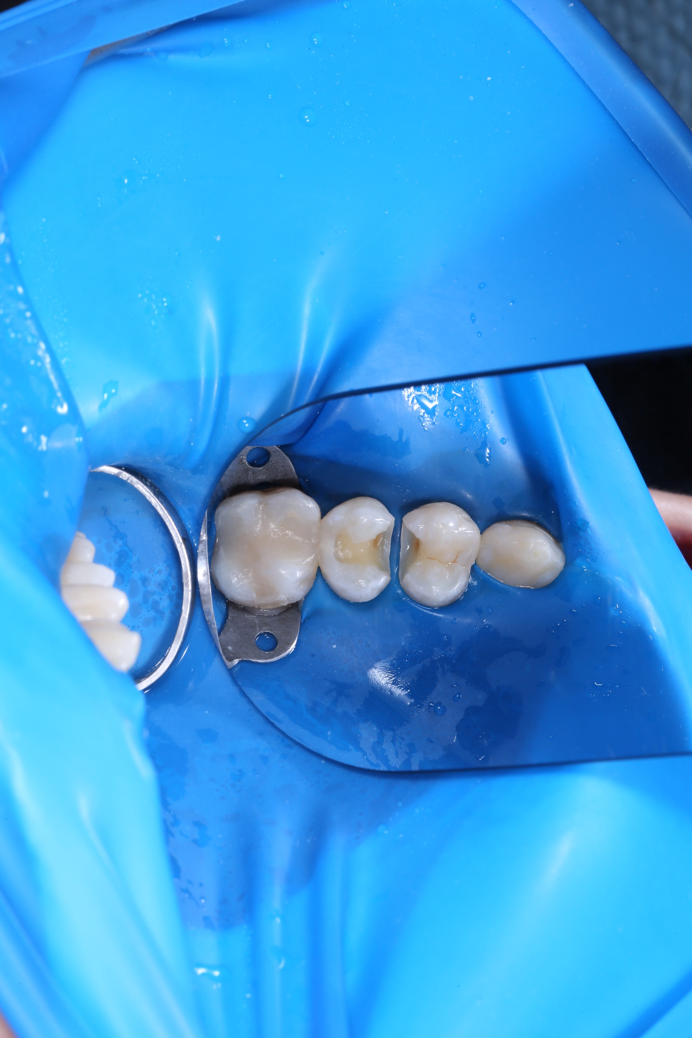 Комплексне відбілювання