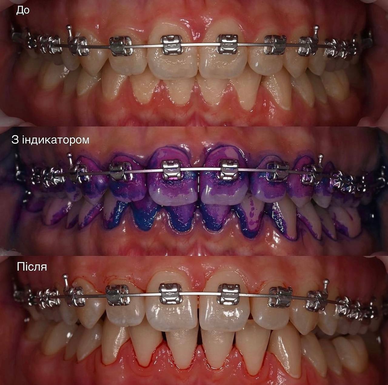 Лікування гінгівіту