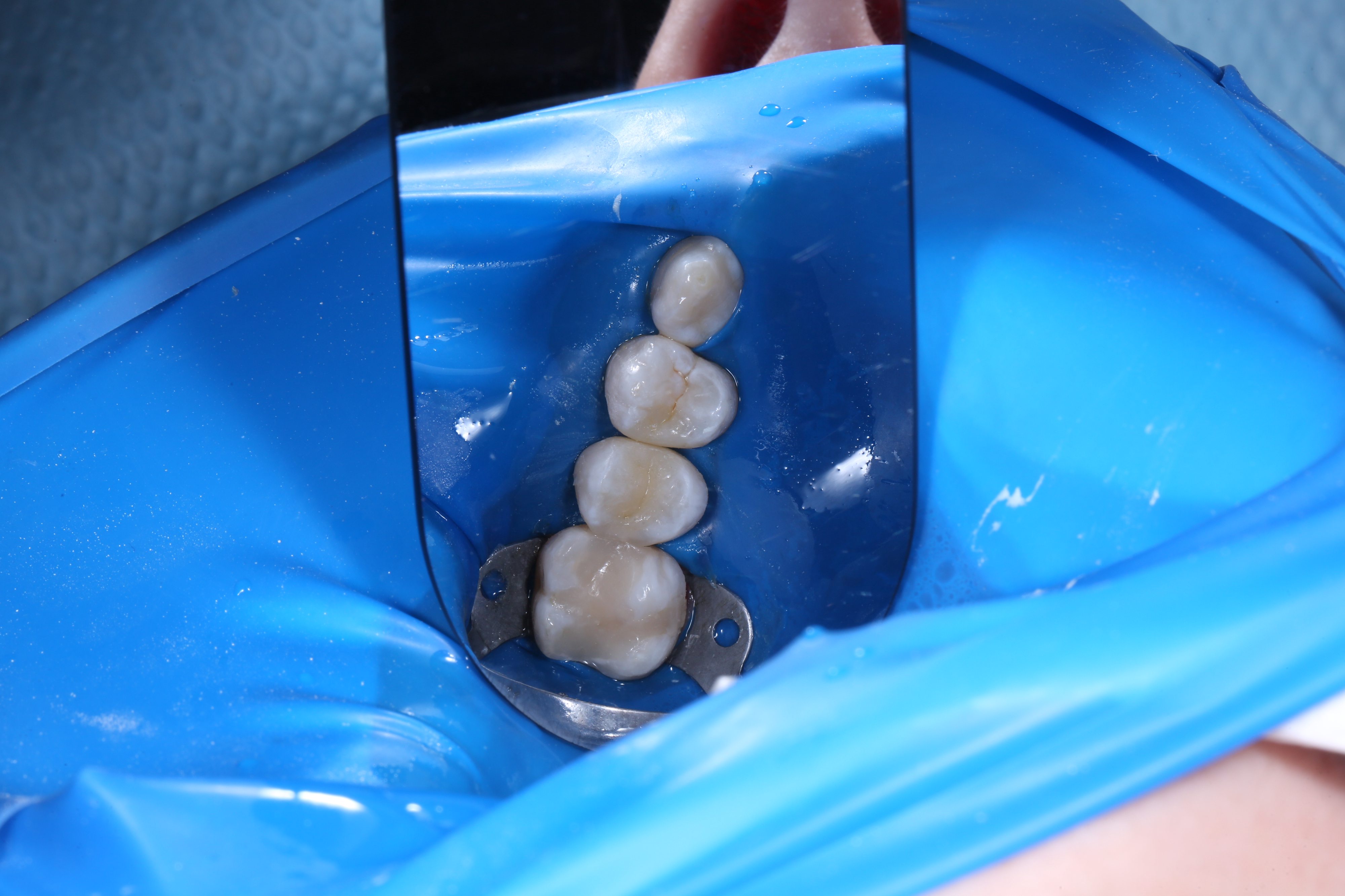 Апаратне відбілювання системою Beyond