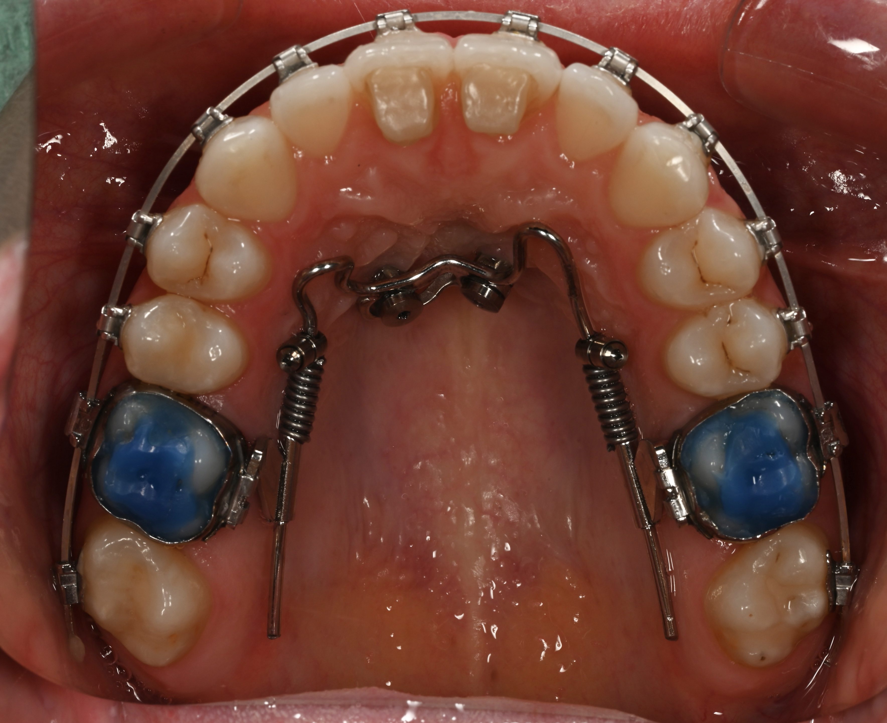 Лікування суглобів