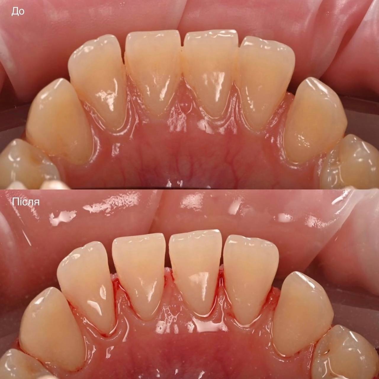 Лікування гінгівіту